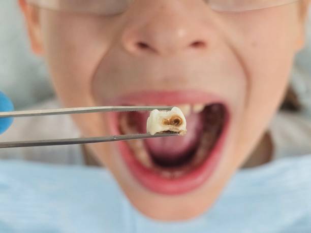 Best Lost Filling or Crown Replacement in Casselberry, FL